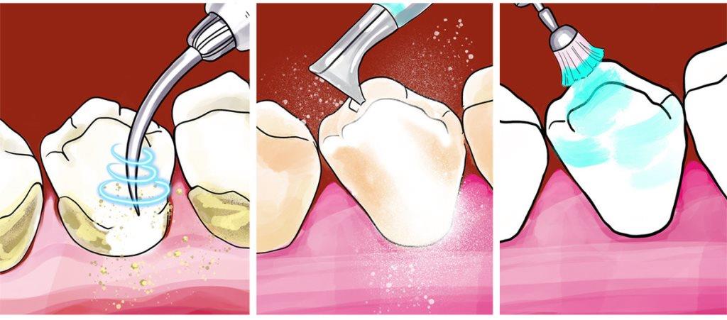 Удаление зубного камня - Стоматология 21 Век, Краснодар