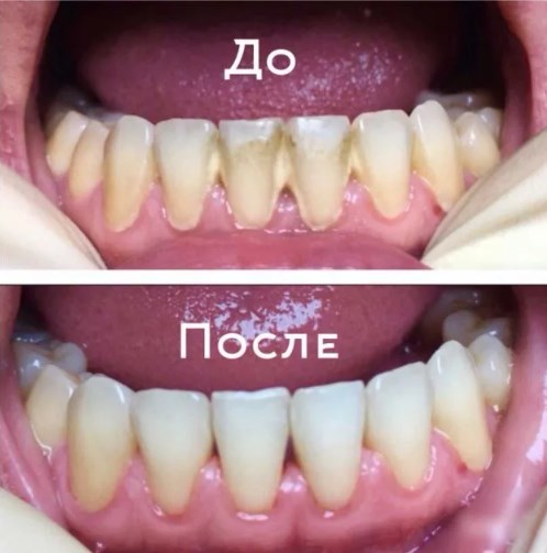 Чистка зубов - стоматология Клиника Прокофьевых, Краснодар