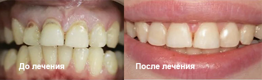 Эрозия эмали зубов - Стоматология 21 Век, Краснодар