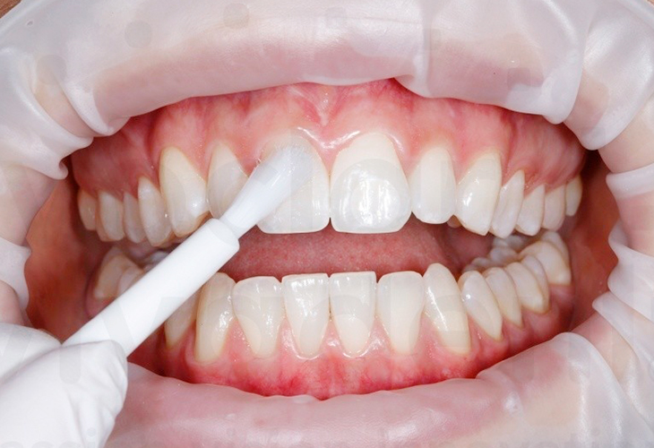 Фторирование зубов - Стоматология 21 Век, Краснодар