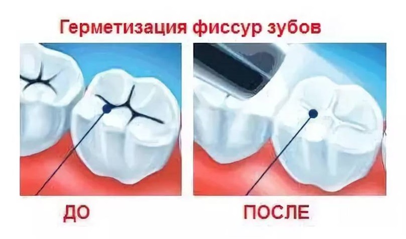 Герметизация фиссур - стоматология Клиника Прокофьевых, Краснодар