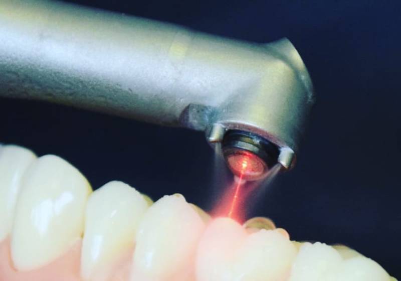 Лечение лазером - стоматология Люция, Владикавказ