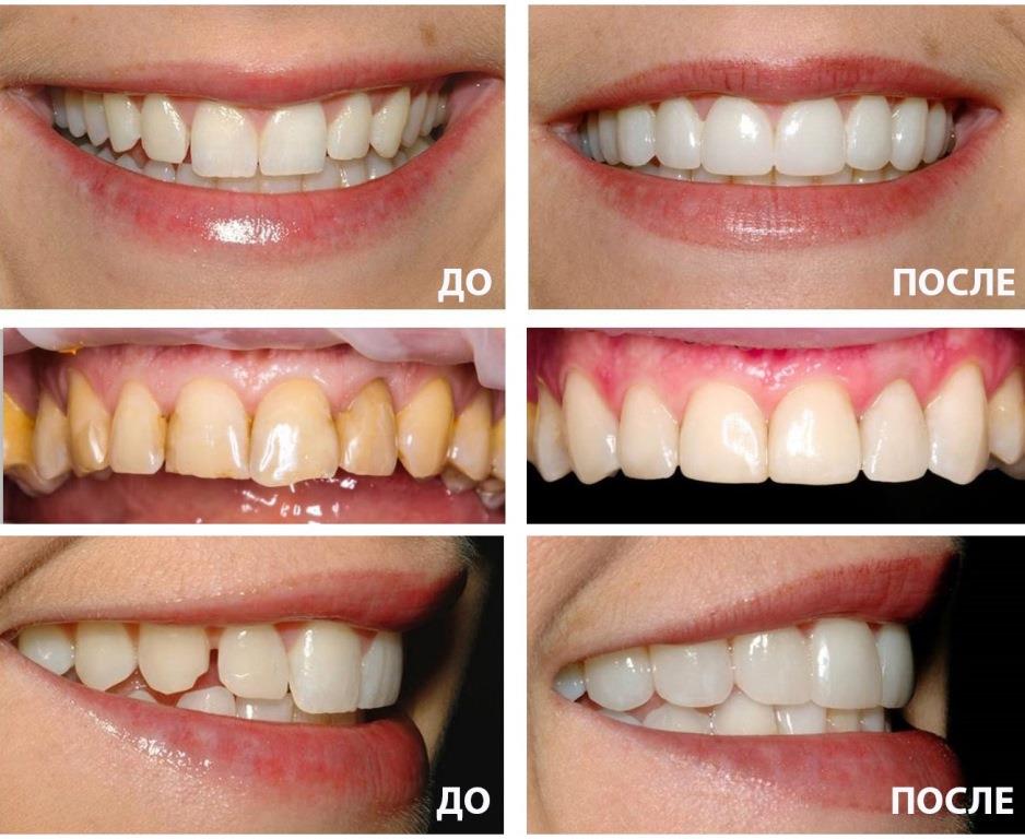 Микропротезирование зубов - стоматология 21 Век, Краснодар