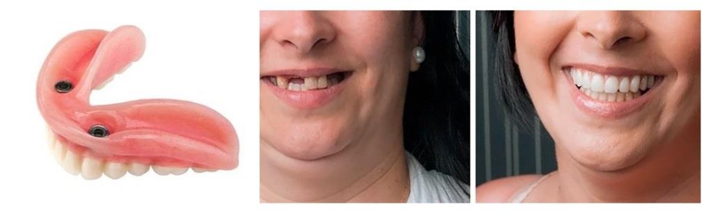 Покрывные протезы - стоматология Люция, Владикавказ