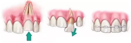 Реплантация зуба - Стоматология 21 Век, Краснодар