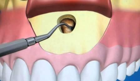 Резекция верхушки корня зуба - стоматология 21 Век, Краснодар